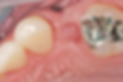单缺后25 earlyplace (2).png