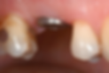 单缺后16 earlyload ITI118 (2).png