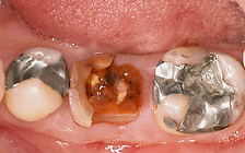 单缺后即刻 (2).png