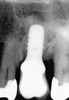 单缺后-26-Iti-155-87y (14).png