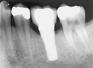 单缺后即刻 (1).png