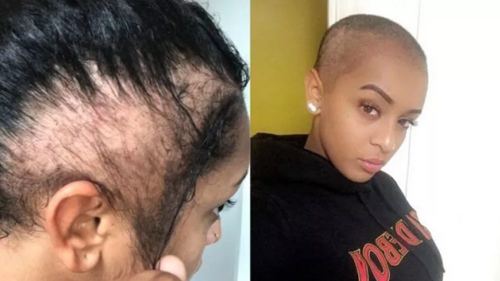 traction-alopecia-young-female-singers-warn-of-self-inflicted-hair-loss