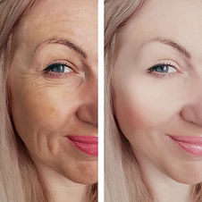 laser hair removal (2).jpg