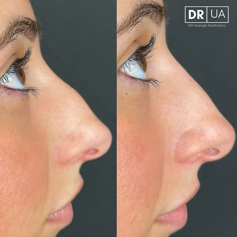 non surgical rhinoplasty