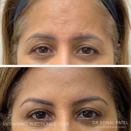 Dermal fillers before and after