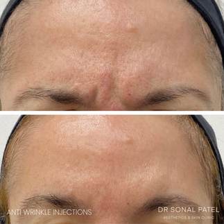 Anti wrinkle injections before and after