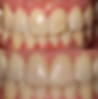 Composite bonding