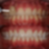 Teeth whitening before and after