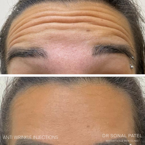 Anti wrinkle injections before and after