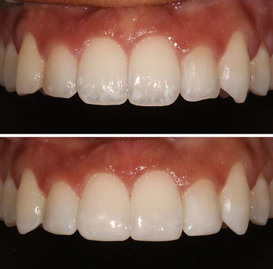 Composite Bonding - before and after