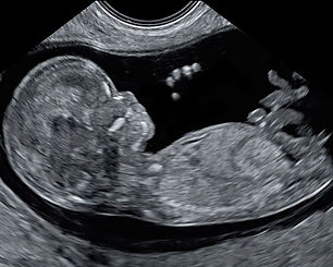 Early-Fetal-Scan-at-12-weeks (Google Image).jpeg