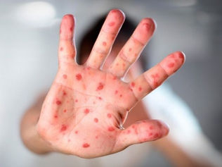 Penyakit tangan kaki dan mulut