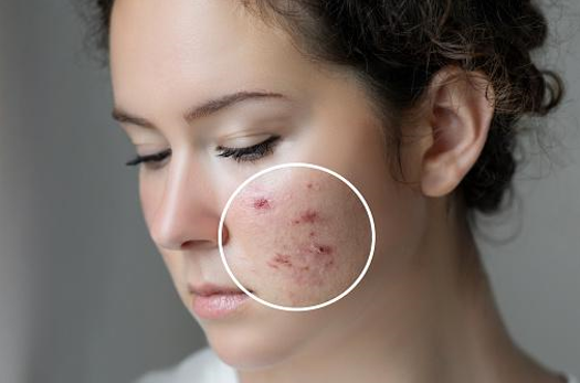How get rid of Active Acne Dubai