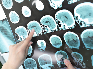 Dependente com esclerose múltipla deve permanecer em plano de saúde da Petrobras