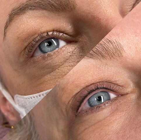 das Vorher und Nachher einer Wimpernkranzverdichtung bei geöffnetem Auge