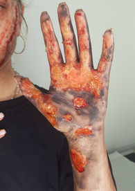 2nd Degree Skin Burns