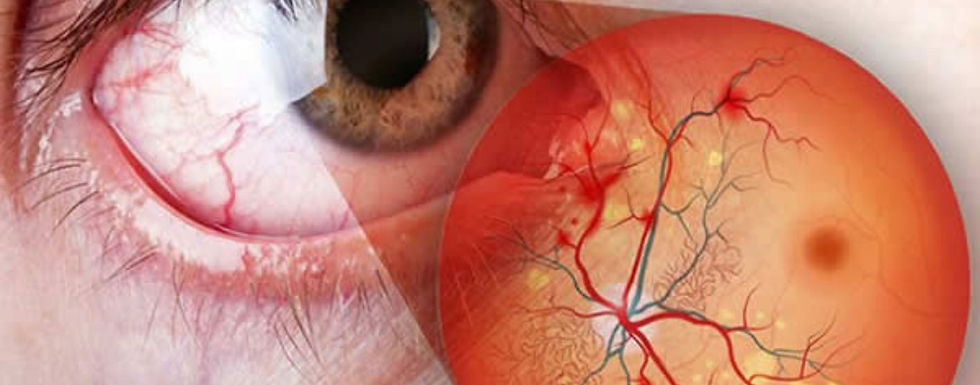 Retinopatia diabética: a principal causa de cegueira irreversível em jovens