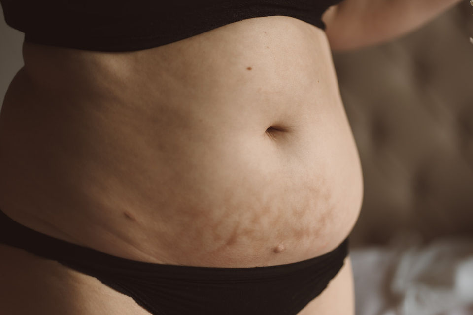 Close-up of a woman's bare stomach showing burn marks due to endometriosis, captured with warmth and no retouching