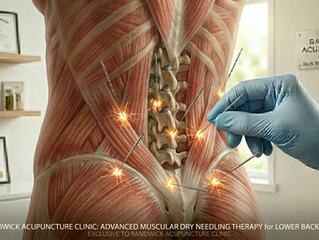 Feeling Stiff or Sore in Randwick? Your Friendly Guide to Dry Needling and Why It Works