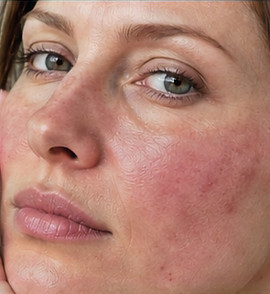 06_rosacea_edited.jpg