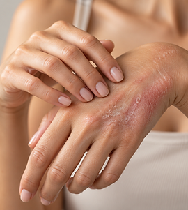 psoriasis.png