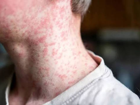 St. Louis County confirms first measles case in 20 years