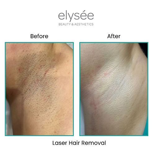 Laser hair removal, before and after treatment