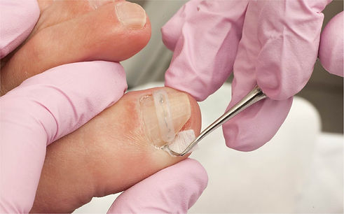 Topical Anti-fungal Solutions_CharlieLauPodiatry3.jpeg