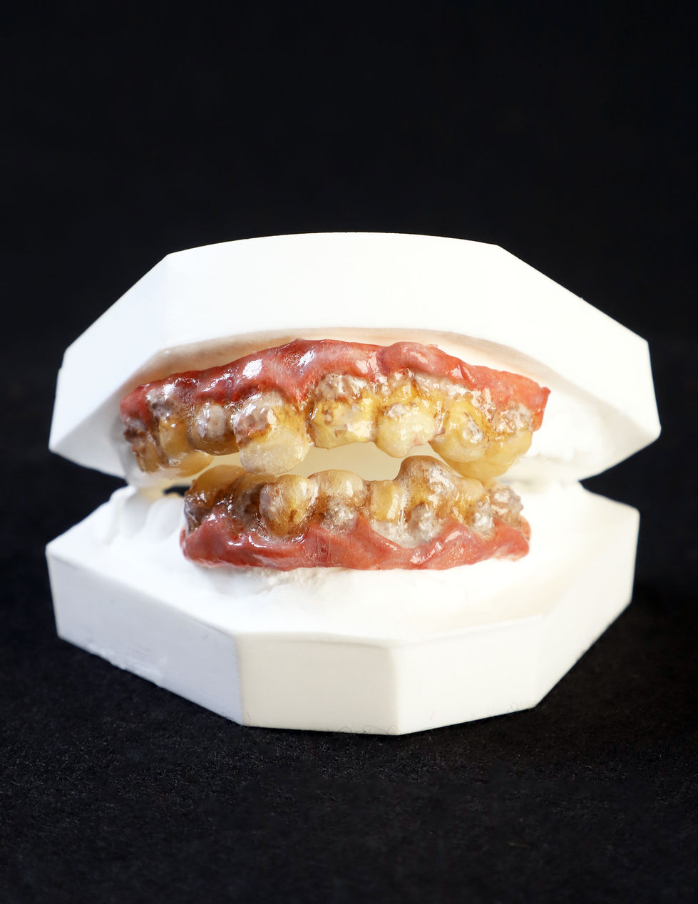 Custom Meth Denture Set (Dental Acrylic)
