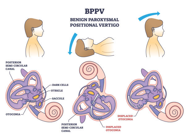 Positional Vertigo