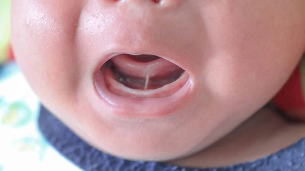Bebê com a boca aberta, mostrando o freio lingual.