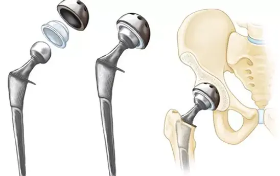 2-featured-compressed-total-hip-3-illustration-compressor.jpg.webp