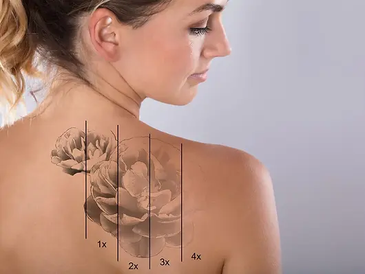 Laser Tattoo Removal