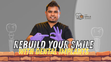 Dental Implants: The “Gold Standard” Missing Tooth Fix