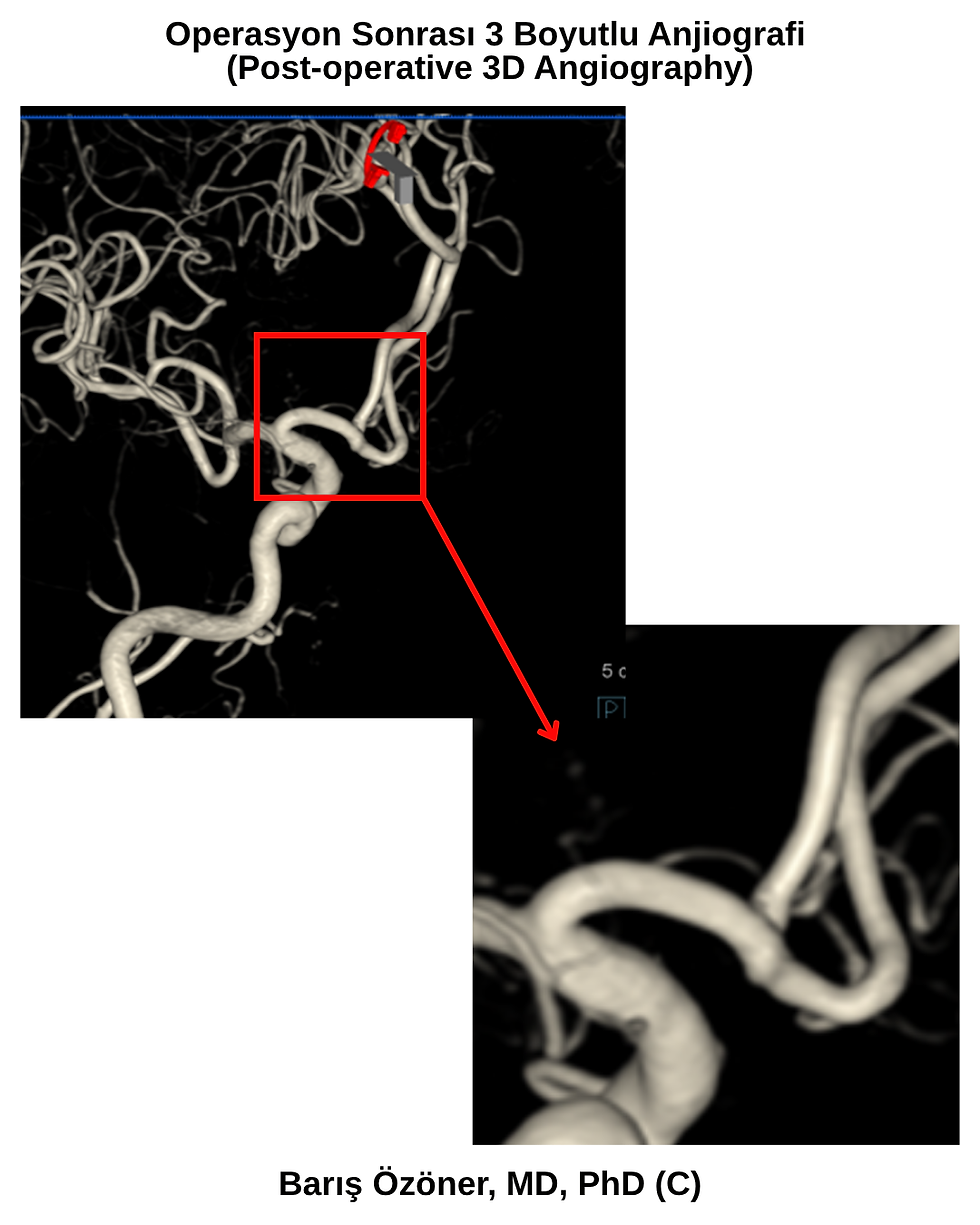 Operasyon sonrası 3 Boyutlu Anjiografide anevrizmanın kapatılmış olduğu ve normal damarsal yapıların devamlılığı görülmektedir. 