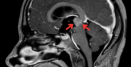 Pineal Parenkimal Tümör (Pineal Bölge Tümörü)