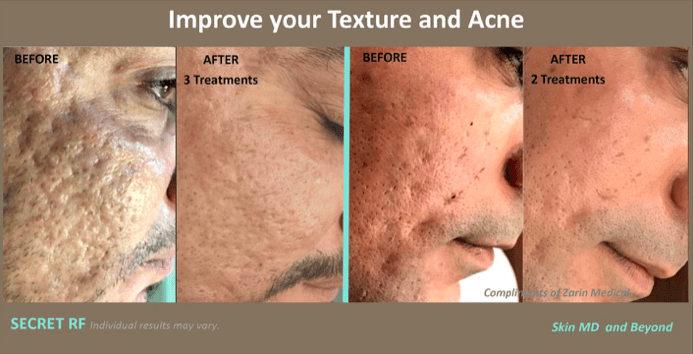 RF Microneedling