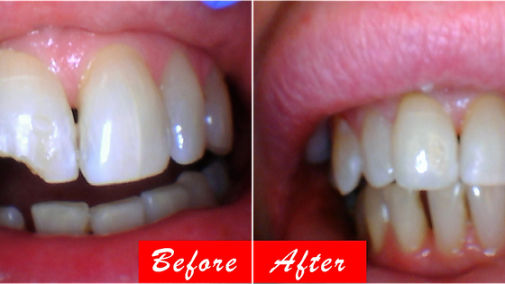Emergency Dental Restorations