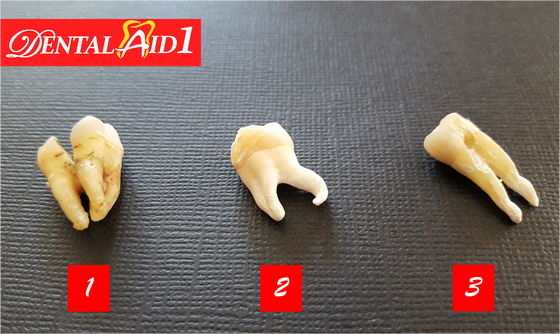 Tooth Extraction Is Our Job