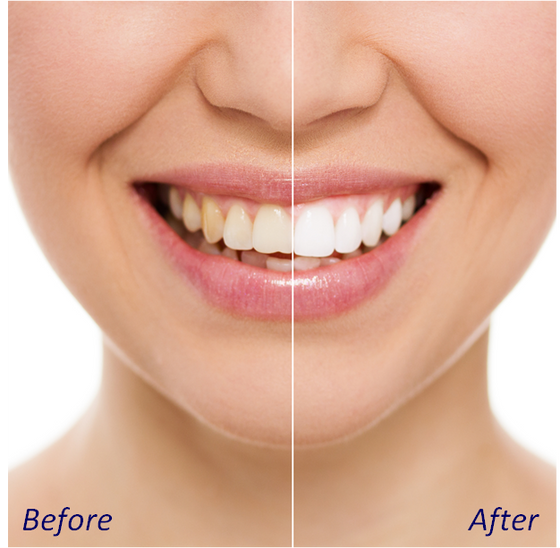 Now Offering: Teeth Whitening