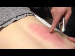 What Causes Bruising After A Massage