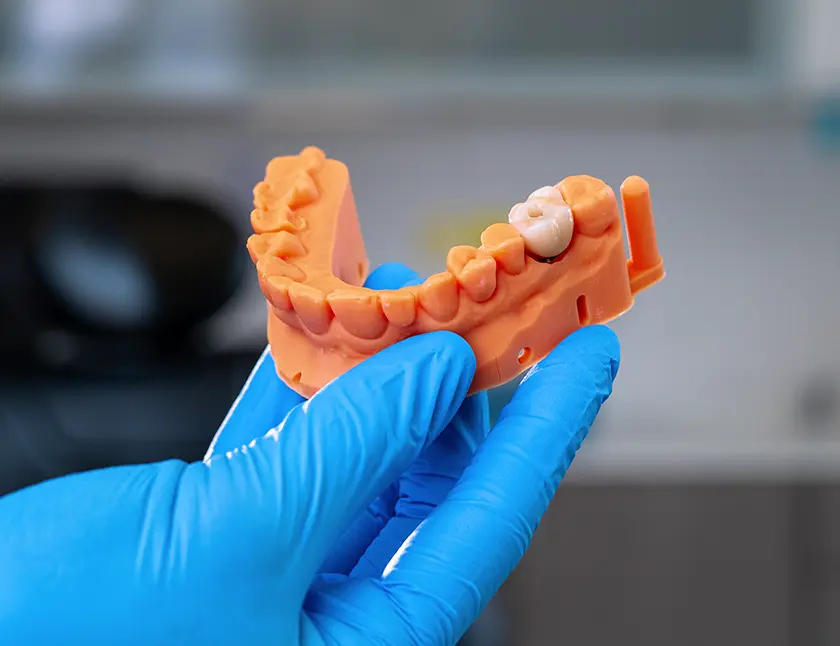 implant-restorations.webp