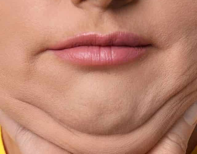 Close-up before photo showing double chin area for reduction treatment at Nova Aesthetic Clinic, Mumbai.