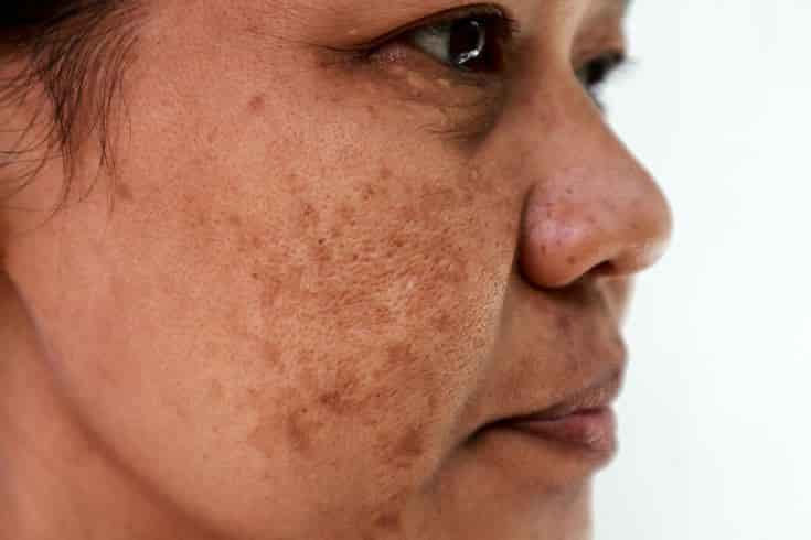 Close-up of facial skin showing brown pigmentation spots and uneven tone, treated at Nova Aesthetic Clinic, Mumbai – advanced pigmentation correction therapy.