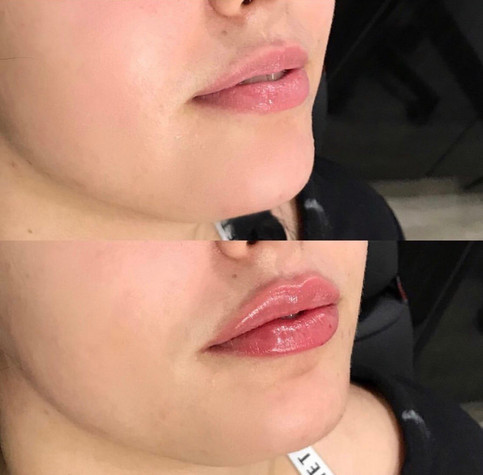 Lip filler