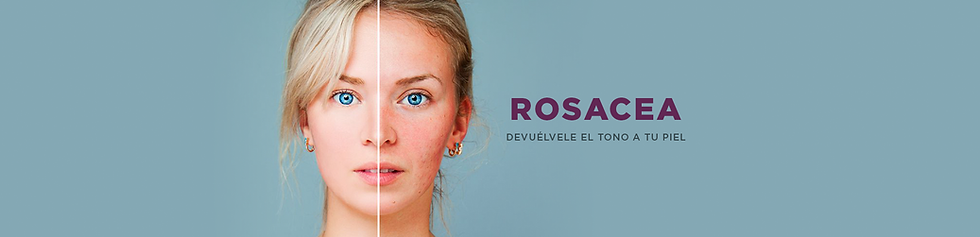 ROSACEA.png
