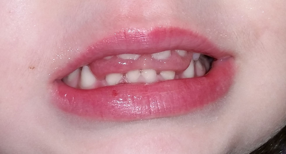 Low Tone and Tongue Posture in Down Syndrome: Improving Speech Clarity