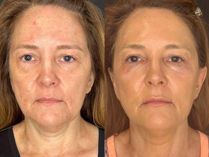 Full Facial Balancing and Rejuvenation