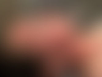 Microneedling in Amarillo, TX