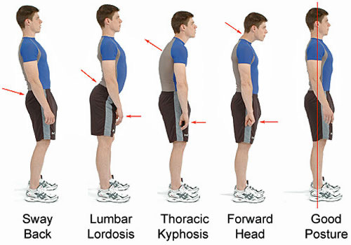 Poor Posture